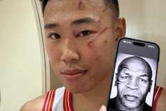 贺希宁晒脸部伤痕对比拳王泰森：如果这是赢球的代价 我愿意?